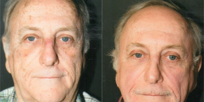 Laser Resurfacing before and after photo