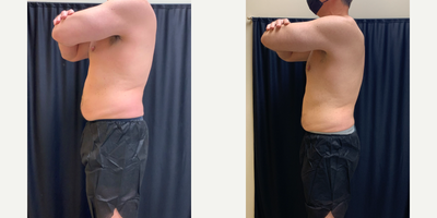 CoolSculpting before and after photo
