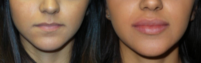 Dermal Fillers before and after photo