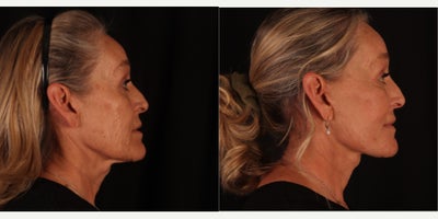 Facelift before and after photo