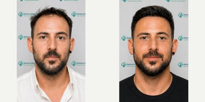 FUE Hair Transplant before and after photo