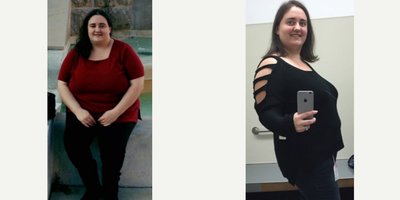 Gastric Sleeve Surgery before and after photo