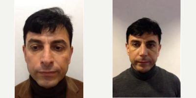 Asian Rhinoplasty before and after photo