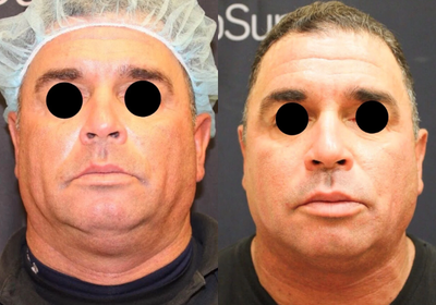 SculpSure before and after photo