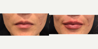 Dermal Fillers before and after photo