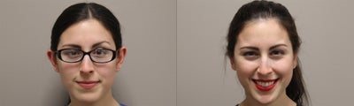 Ear Surgery before and after photo