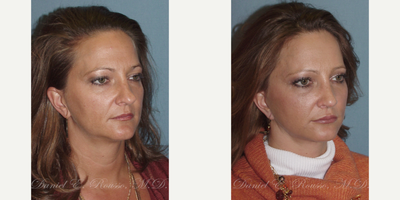 Mini Facelift before and after photo