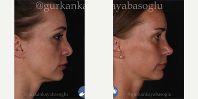 Revision Rhinoplasty before and after photo