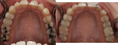 Tooth Repair before and after photo
