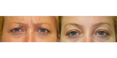 Botox before and after photo