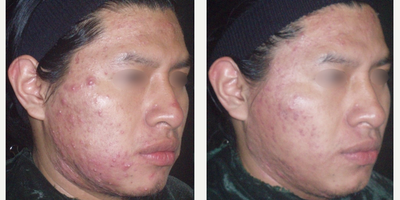 Chemical Peel before and after photo