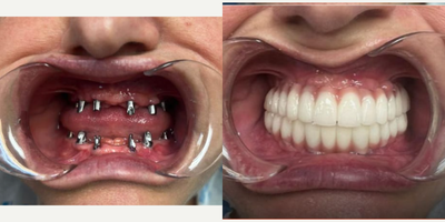 Dental Bridge before and after photo