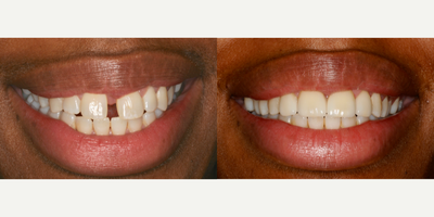 Porcelain Veneers before and after photo