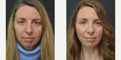 Revision Rhinoplasty before and after photo
