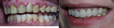Smile Makeover before and after photo