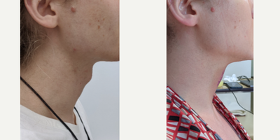 Adam's Apple Reduction before and after photo
