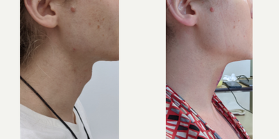 Adam's Apple Reduction before and after photo