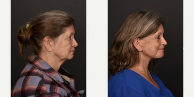 Facelift before and after photo