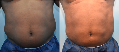Laser Liposuction before and after photo