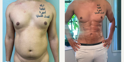Abdominal Etching before and after photo