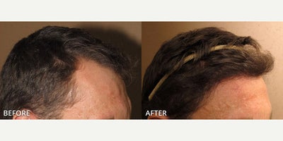ARTAS Robotic Hair Transplant before and after photo