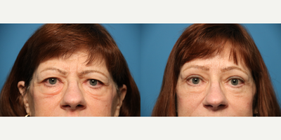 Eyelid Surgery before and after photo