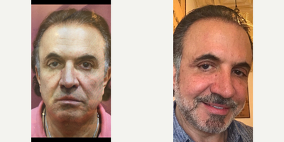 Facelift before and after photo