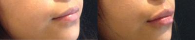 Juvederm before and after photo