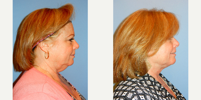 Liposuction before and after photo