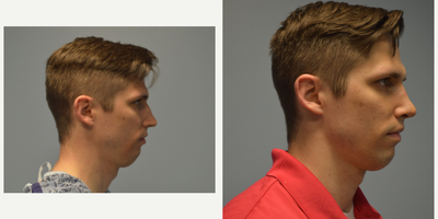 Rhinoplasty before and after photo