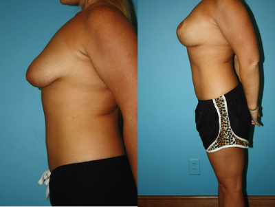 Breast Augmentation before and after photo