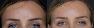 Dermal Fillers before and after photo