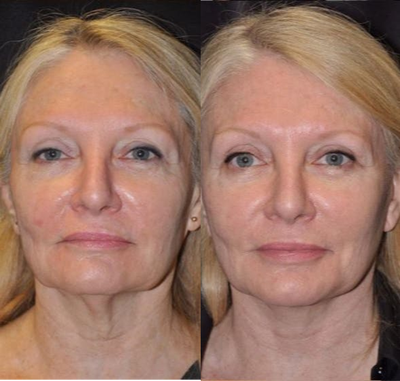 Facelift before and after photo