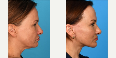 Facelift before and after photo