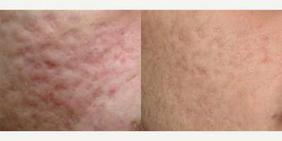 Fractional Laser before and after photo