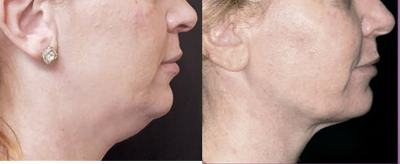 Kybella before and after photo