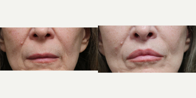 Lip Lift before and after photo