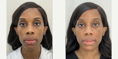 Restylane before and after photo