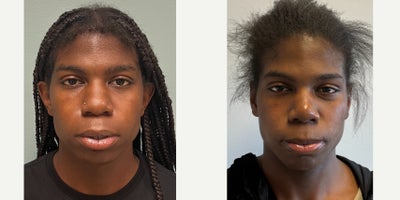 Septoplasty before and after photo