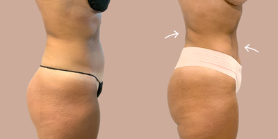 AirSculpt before and after photo