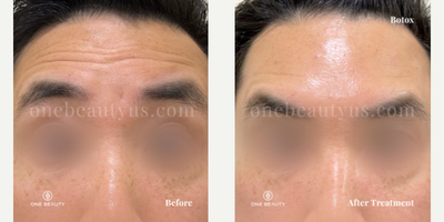 Botox before and after photo
