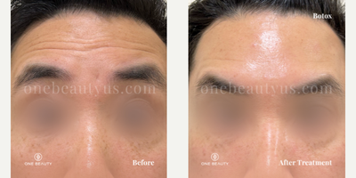 Botox before and after photo