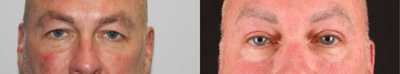 Eyelid Surgery before and after photo