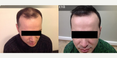 Hair Transplant before and after photo