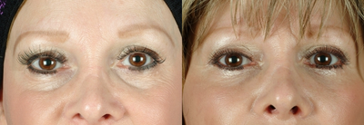 Juvederm before and after photo