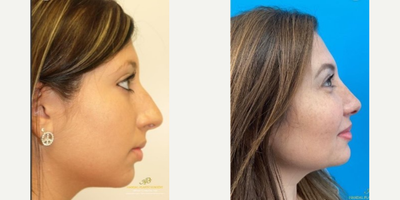 Rhinoplasty before and after photo