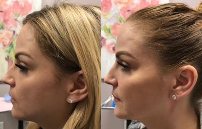 Voluma before and after photo