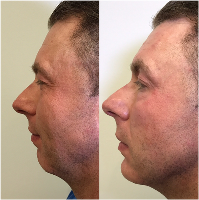 Chin Filler before and after photo