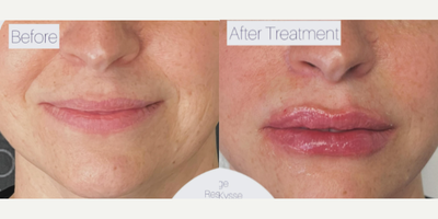 Dermal Fillers before and after photo