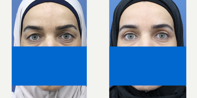 Eyelid Surgery before and after photo